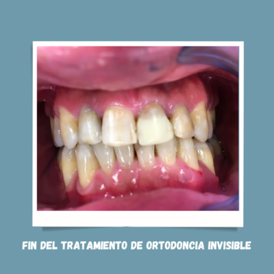 ORTODONCIA INVISIBLE