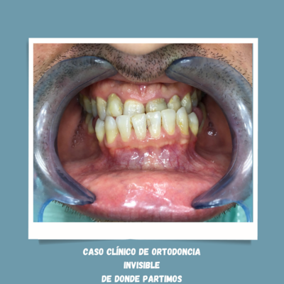 ORTODONCIA INVISIBLE